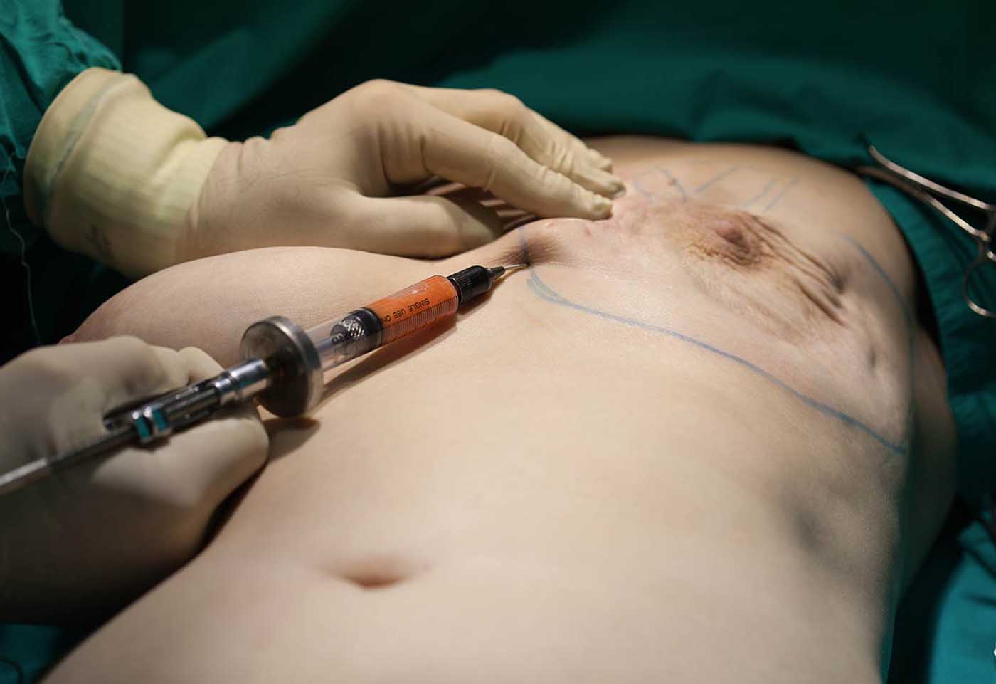 Lipofilling mammaire