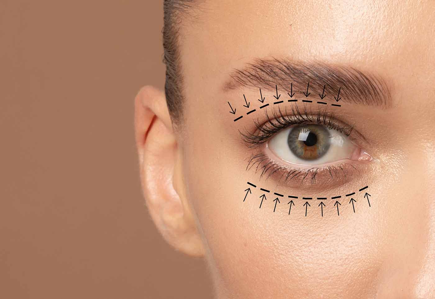 blépharoplastie