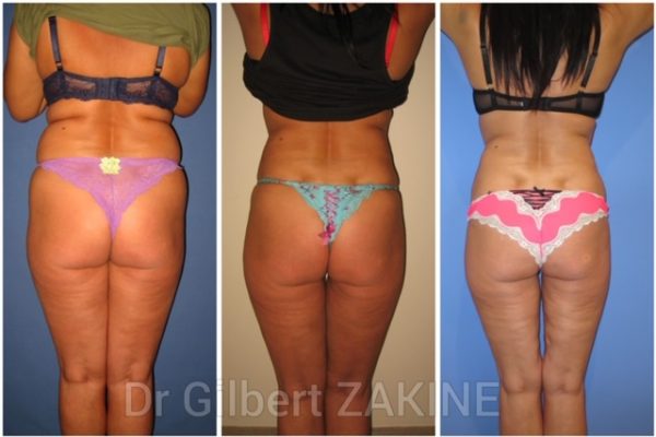 Lipoaspiration 1