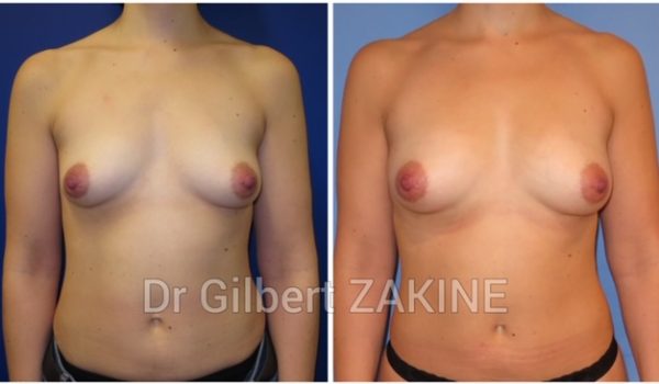 Lipofilling seins 1