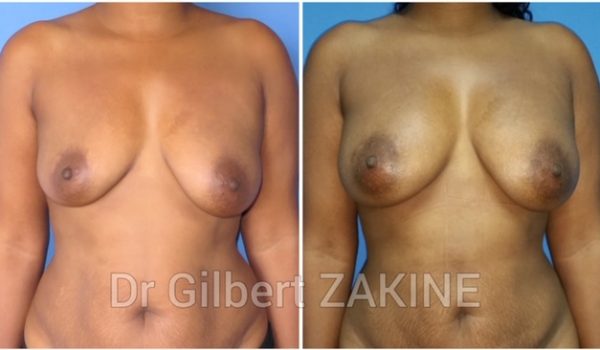 Lipofilling seins 3