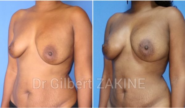 Lipofilling seins 4