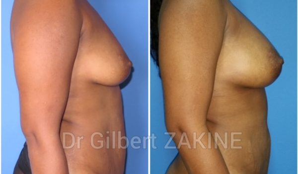 Lipofilling seins 5