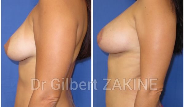 Lipofilling seins 8