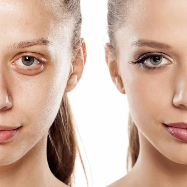 blépharoplastie chirurgie des paupières