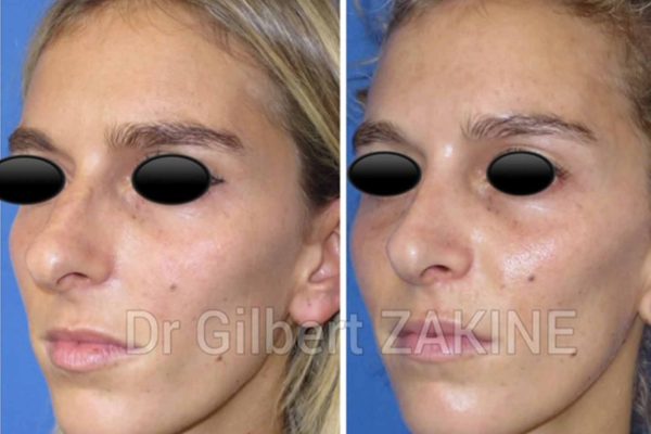 nez caucasien femme 2