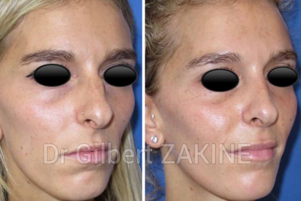 nez caucasien femme1