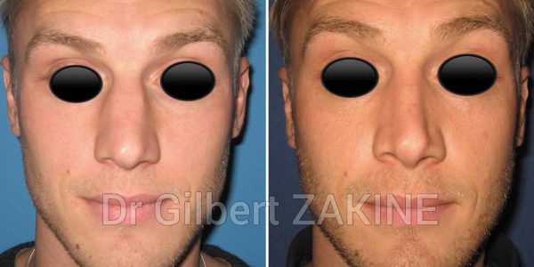 nez caucasien homme
