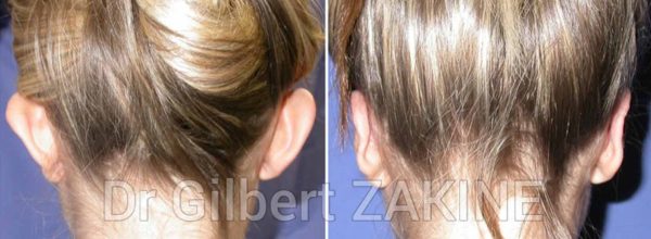 otoplastie femme