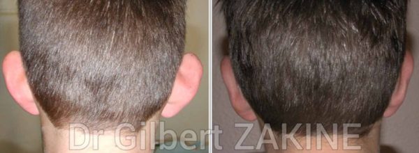 otoplastie