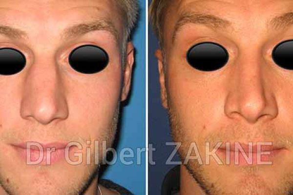 rhinoplastie esthétique homme rhinoplastie esthétique homme