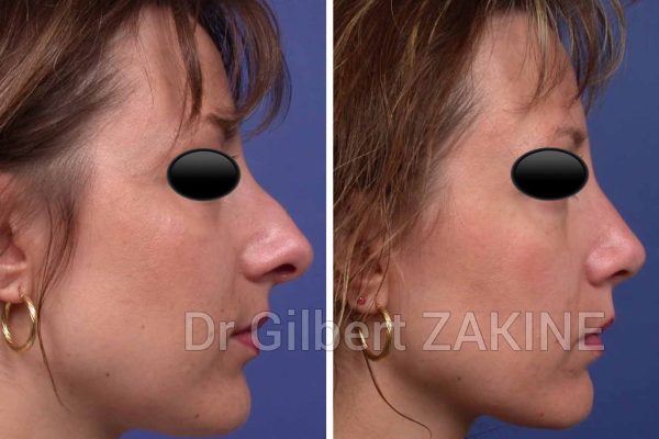 rhinoplastie1