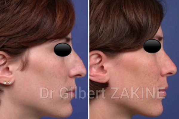 rhinoplastie2