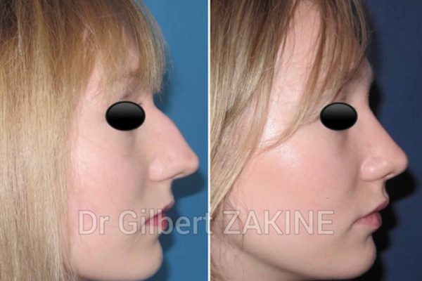 rhinoplastie3